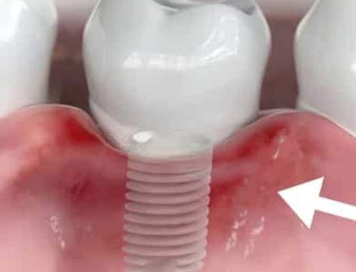 Implantes dentales: Qué es la periimplantitis