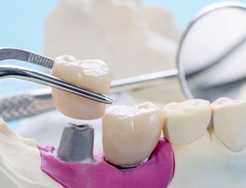 Carilla vs. corona dental: ¿Qué diferencia hay?