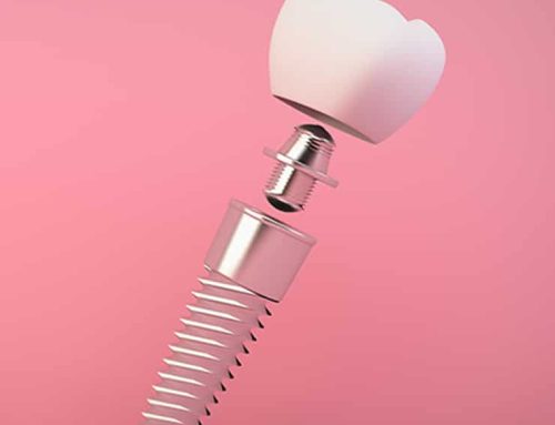 Implantes dentales: Causas y síntomas de rechazo